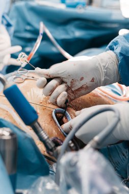 Eldiven ve mavi önlük giyen bir kalp cerrahı, iyi donanımlı bir ameliyathanede ameliyat sırasında bir hasta üzerinde cerrahi aletler kullanır.