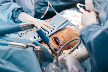 Mavi önlüklü bir kalp cerrahı ameliyat odasında tıbbi aletler ve steril perdeler ile çevrili açık göğüs boşluğunun üzerinde cerrahi aletler kullanır.