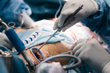 Açık kalp ameliyatında kalp kapakçığı implantasyonu yapılır, steril bir ameliyathanede cerrahi aletler ve tıbbi personel sergilenir.