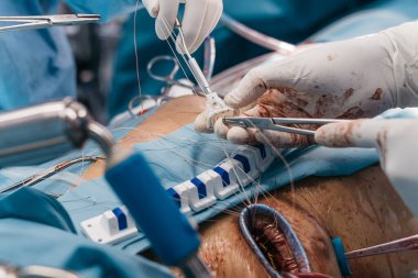 Açık kalp ameliyatında kalp kapakçığı implantasyonu yapılır, steril bir ameliyathanede cerrahi aletler ve tıbbi personel sergilenir.