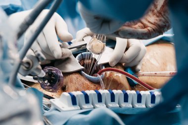 Kalp kapakçığı implantasyonu bir ameliyathanede gerçekleştirilir, cerrahi aletler ve steril giyimli tıbbi personel gösterilir.