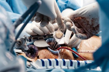 Cerrahi ekip açık kalp ameliyatı sırasında kalp kapakçığı implantasyonu, steril eldiven ve klinik ortamlarda cerrahi aletler yapıyor.