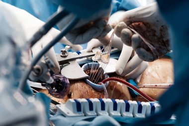 Kalp kapakçığı implantasyonu bir ameliyathanede gerçekleşiyor, cerrahi aletler ve steril giyimli tıbbi personel gösteriliyor.