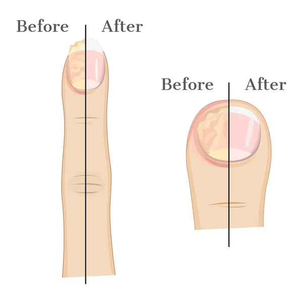 Infecção fúngica da unha —  Vetores de Stock