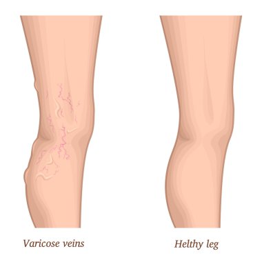 Illustration of varicose veins clipart