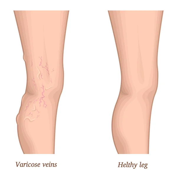 Illustrazione delle vene varicose — Vettoriale Stock