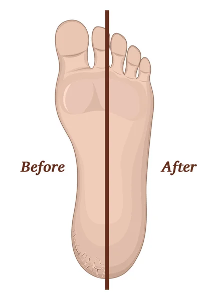 Sprickor i huden på foten — Stock vektor