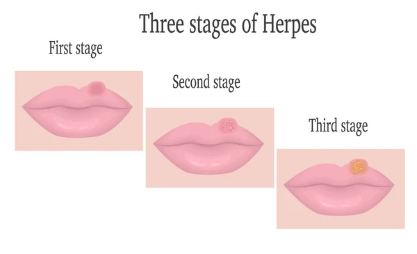 Herpes na rtech — Stockový vektor