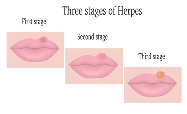 Herpes di bibir - Stok Vektor