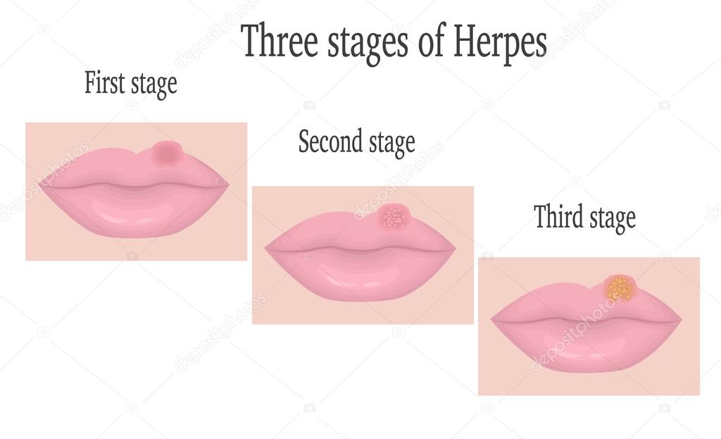Vektorgrafiken Herpes Simplex Virus Vektorbilder Herpes Simplex Virus Depositphotos