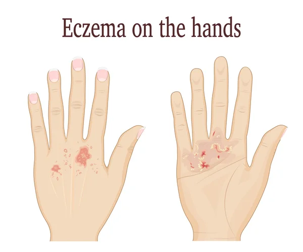 Eczema nas mãos — Vetor de Stock