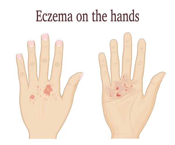 Eczema on the hands — Stock Vector