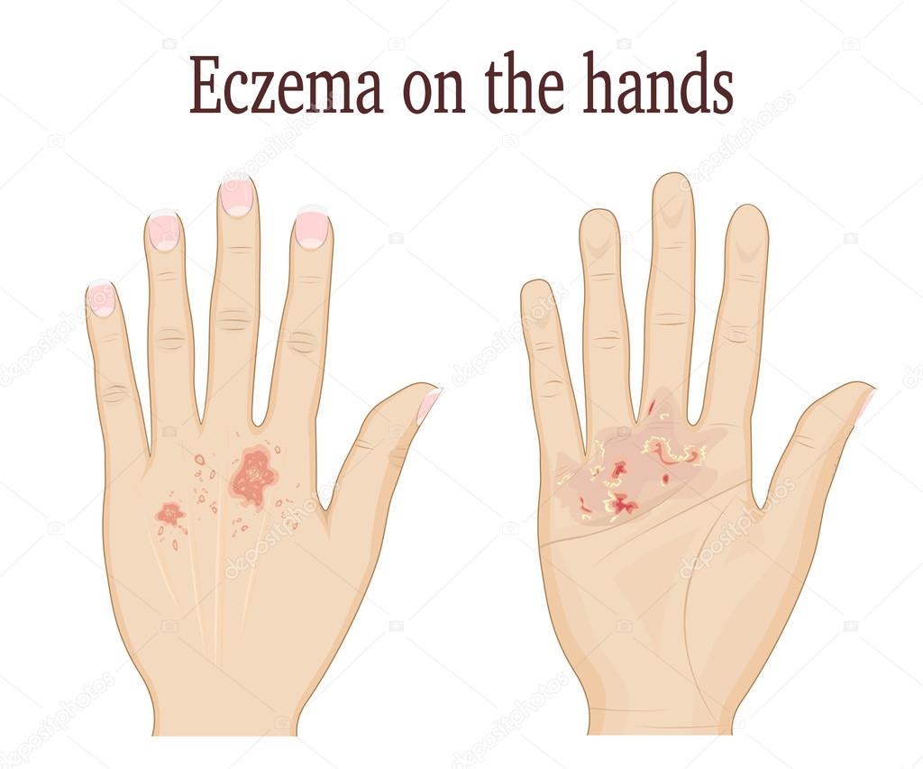 Ellerde egzama nasıl tedavi edilir Ellerde egzama nasıl tedavi edilir