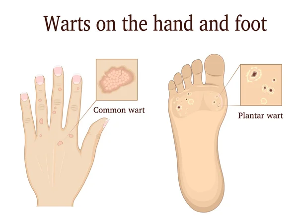 Warts on the hand and foot — Stock Vector