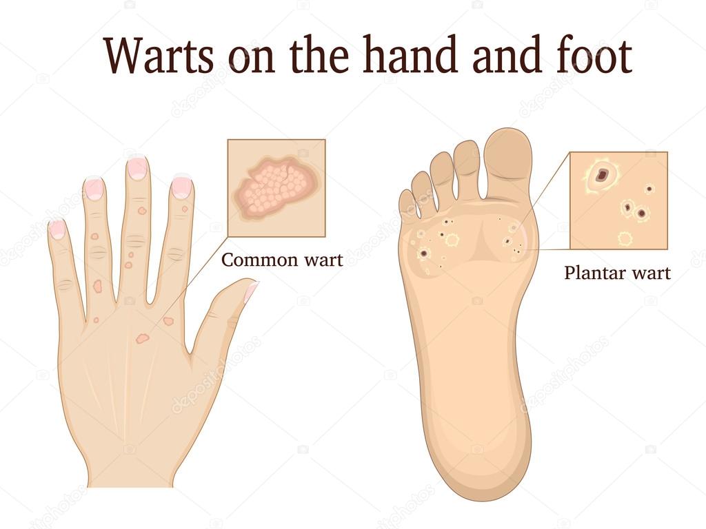 Warts on the hand and foot