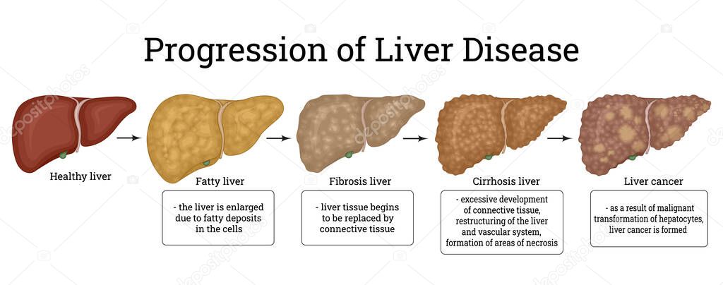 Stages of liver damage such as Fatty liver, Fibrosis, Cirrhosis, and Liver cancer