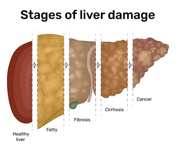 Ilustración Progresión Enfermedad Hepática Del Hígado Graso Cáncer — Archivo Imágenes Vectoriales