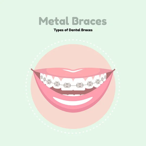 Aparelho Dental metal. —  Vetores de Stock