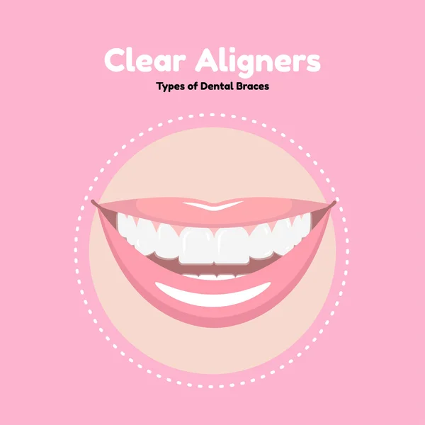 Aligeradores dentales claros . — Archivo Imágenes Vectoriales