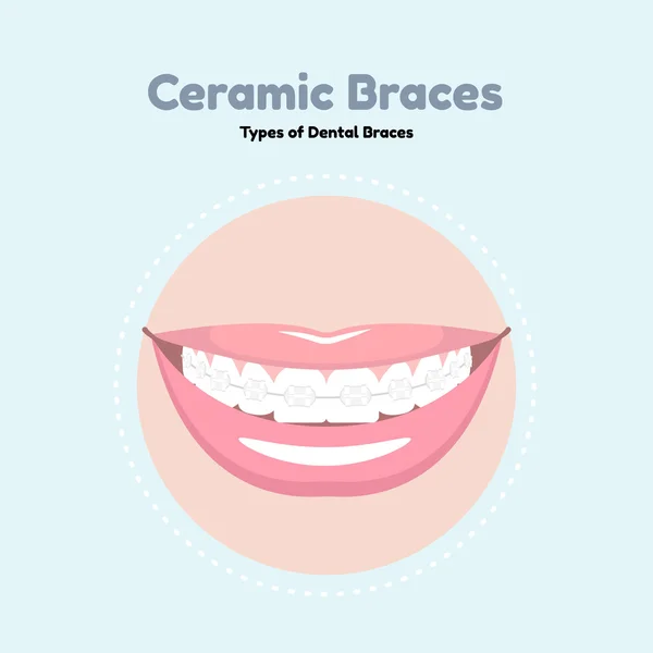 Frenos dentales de cerámica . — Archivo Imágenes Vectoriales