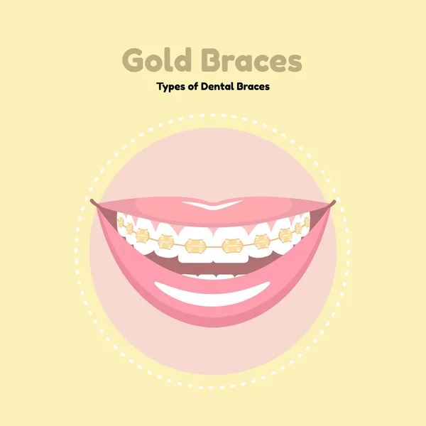 Gold Dental Braces. — Stock Vector