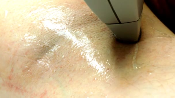 Man blir underarm laser hårborttagning — Stockvideo