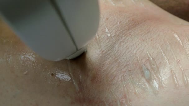 L'uomo ottiene depilazione laser sotto le ascelle — Video Stock