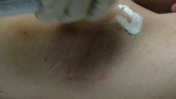 Мужчина получает лазерную эпиляцию подмышки — стоковое видео
