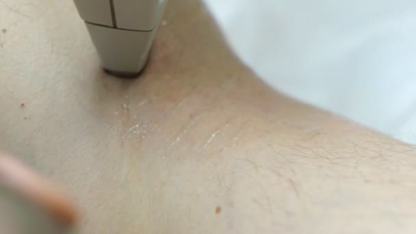 Homem fica underarm laser depilação — Vídeo de Stock