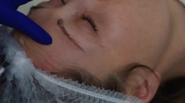 Doktor-kozmetik uzmanının yakın çekimi botulinum toksini alnına enjeksiyon yapıyor..