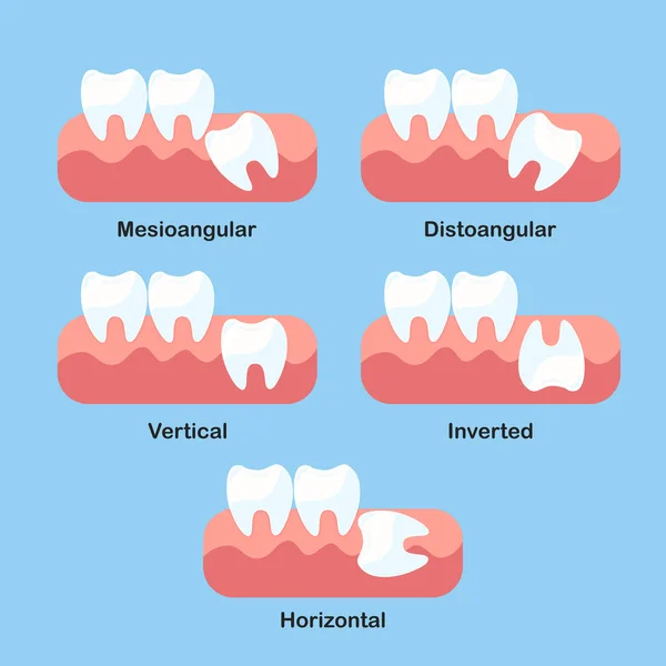 知恵歯の影響問題アイコンセット — ストックベクタ