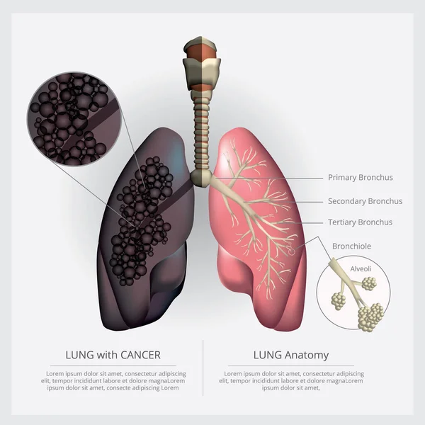 Πνεύμονας Λεπτομέρεια Και Τον Καρκίνο Του Πνεύμονα Διανυσματική Απεικόνιση Διανυσματικά Γραφικά