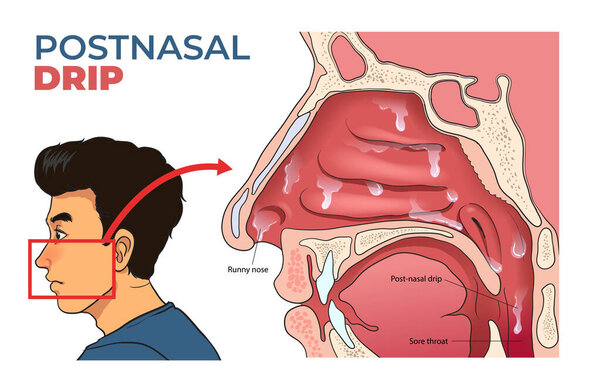иллюстрация Postnasal Drip диаграммы