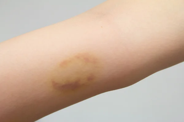 Prellungen am verletzten weiblichen Arm — Stockfoto