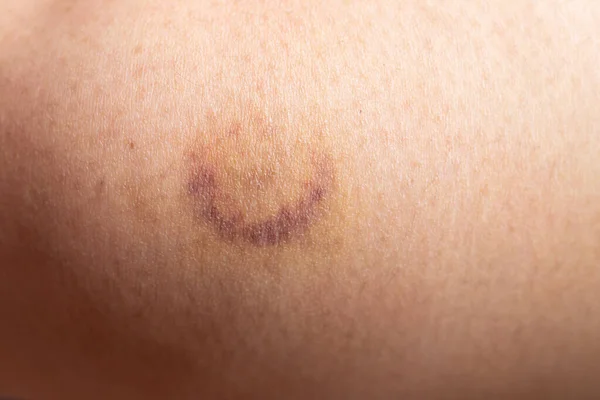 Closed Background Bruise Wound Wound Woman Leg Skin — Stock Photo, Image