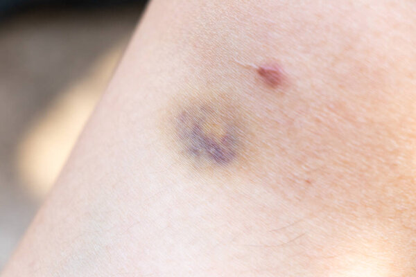 Закрытый фон фиолетового поражения на коже азиатки