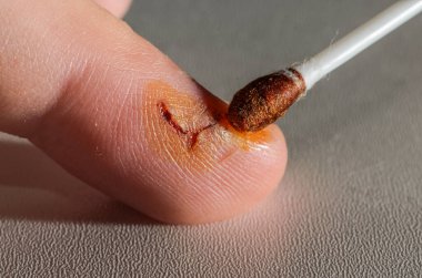 Doktor parmağındaki yarayı iyot antiseptikle tedavi eder.