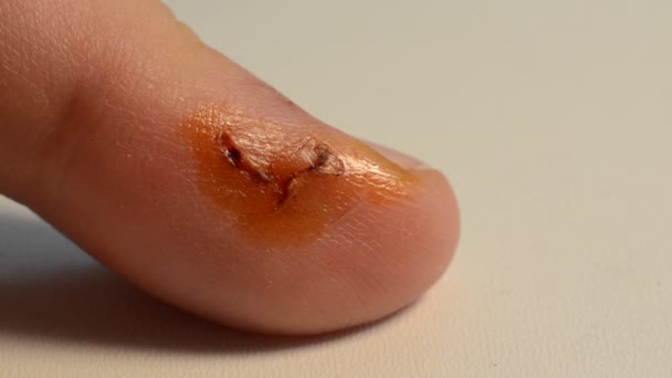 Läkaren Behandlar Ett Sår Ett Finger Med Jod Antiseptisk — Stockvideo