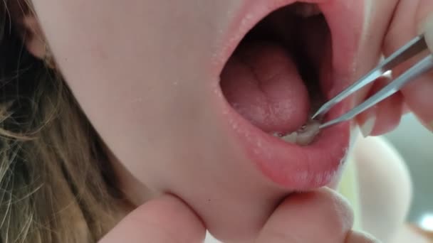 Dentist Wiggles Baby Milk Tooth Tweezers — Video Stock
