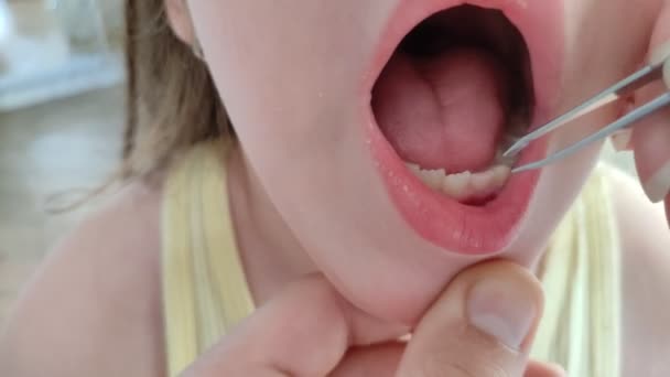 Dentist Wiggles Baby Milk Tooth Tweezers — Stock videók