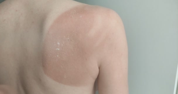 Médecin Fournit Les Premiers Soins Pour Les Coups Soleil Dos — Video