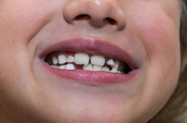 Little girl child wagging her baby tooth with her tongue, which should fall out
