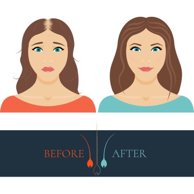 Saç tedavisi sonrası anf önce Balding kadın