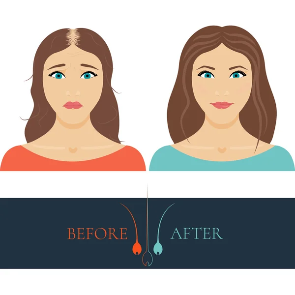 Mujer calva antes de anf después del tratamiento del cabello — Vector de stock