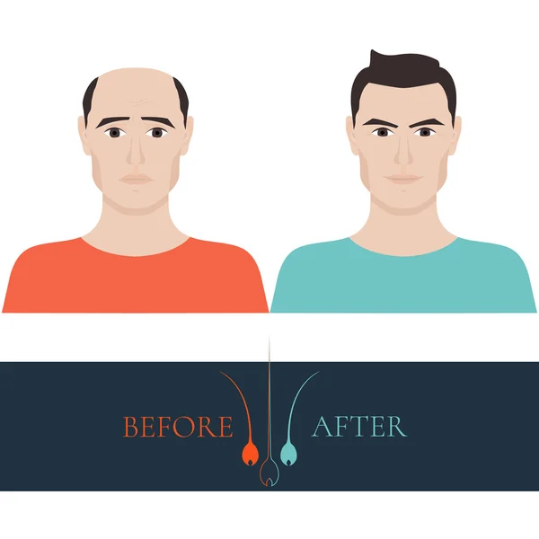 Antes y después del tratamiento de pérdida de cabello — Vector de stock