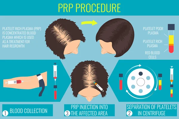 Procedimento de plasma rico em plaquetas para uma mulher —  Vetores de Stock