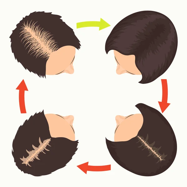 Female pattern hair loss stages — Stock Vector