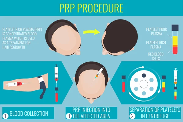 Procedimiento de plasma rico en plaquetas para un hombre — Vector de stock