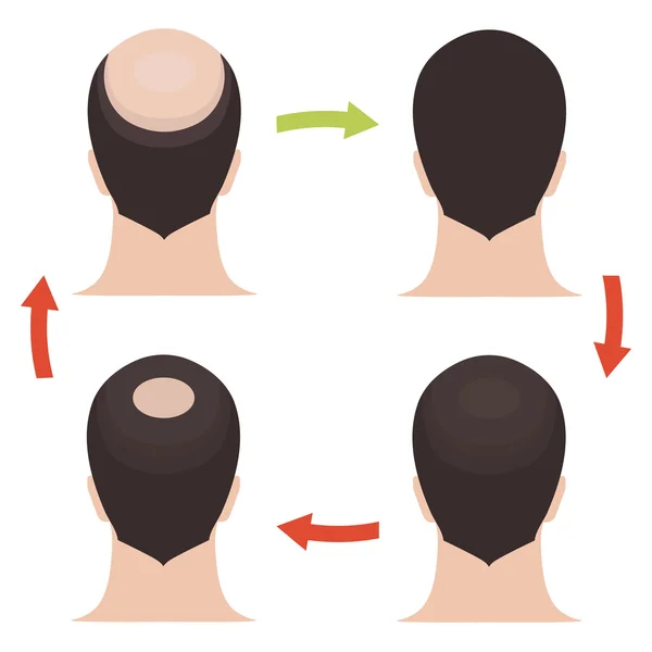 Erkek saç kaybı aşamaları kümesi — Stok Vektör
