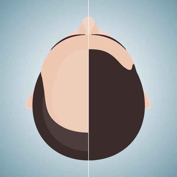 Bald man before and after hair transplantation — Stock Vector